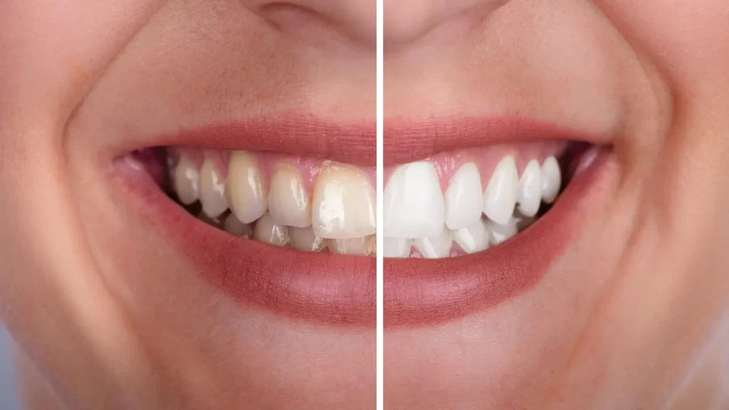 teeth whitening before and after - laser