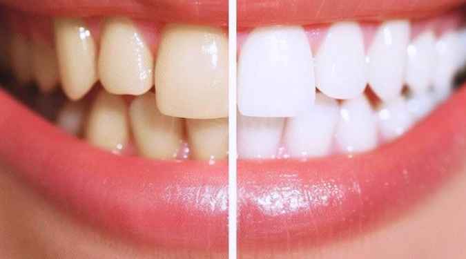 Cosmetic Teeth Whitening before and after results at Ivory Teeth Whitening in Edmonton.